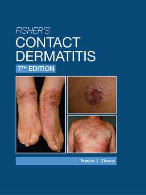 cover image of Fisher's Contact Dermatitis--